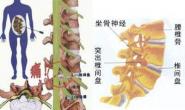 针刀松解治疗腰椎管狭窄症１６０例分析