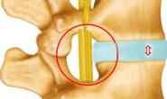 腰椎间盘突出的针刀治疗定位与操作技巧