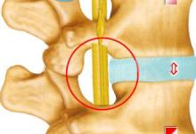 腰椎间盘突出的针刀治疗定位与操作技巧