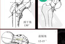 针刀治疗骨头坏死定点及操作精要